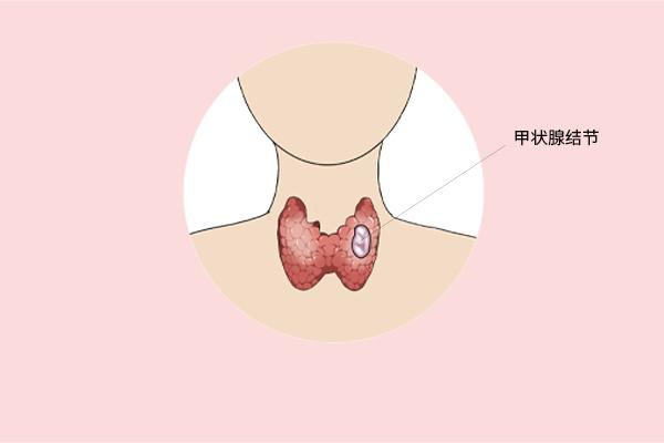 甲狀腺癌癥的主要癥狀表現(xiàn)有什么？為什么會得甲狀腺癌癥呢？