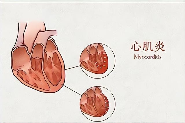 心肌炎的癥狀有哪些？心肌炎的主要變現(xiàn)癥狀有啥？